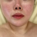 102 | 서산피부관리 성연 로엔에스테틱 리프팅케어 추천! 성연피부샵 리얼 후기