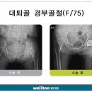 [고관절인공관절] 고관절 골절, 가볍게 봤다간 큰 일! 초기에 관리 필요 이미지