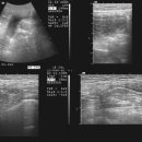 Mechanical bowel ileus patterns 이미지