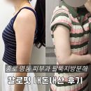 칼로 - 전주시 덕진구 기린대로 508 | 종로 명동 피부과 팔뚝지방분해 칼로핏 내돈내산 후기