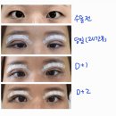 남대구약국 | [30대 여자/대구] 쌍커풀 수술 2주까지 후기(긴글주의)
