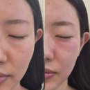 월드크리닝진해지사 | 김해 에스테틱 얼굴 리프팅 후기｜눈밑 꺼짐·팔자·턱라인 처짐 알테온 관리