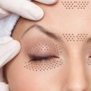 보톡스, 필러는 이제 그만하세요!!!Fibroblast Treatment 으로 다 해결됩니다~ 이미지