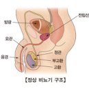 전립선암 이미지