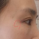 내돈내산 엑스팟 엑스솔루션 편평사마귀 쥐젖 좁쌀여드름 비립종 효과 솔직후기 부작용