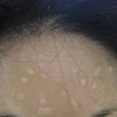 장미꽃과 나이팅게일 피부과의원 | 우만동 장미꽃과 나이팅게일 피부과에서 동생과 함께 피부관리/ 연말 특급 이벤트!! "주인공은....바로...