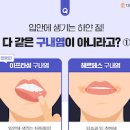 아프타성 구내염 원인 입안 잇몸 혀 헐었을 때 구내염 빨리 낫는법 이미지