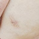 아름다운향기유외과의원 | 영통 아름다운향기유외과에서 섬유선종 맘모톰 수술 후기!