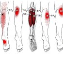 비복근(gastrocnemius muscle) 이미지