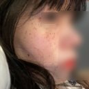 압구정루비레이저 후기