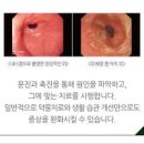 위궤양 초기 증상과 치료 약 무엇이 있을까? 이미지