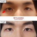 제니성형외과의원 | 뒤트임복원 후기 붙지 않게 리터닝 눈꼬리리프팅으로 해결!