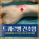 더편한정형외과의원 | 부평정형외과 드퀘르벵 손목 통증 치료 및 관리 방법
