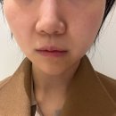 청담피부과 튠페이스효과 주기 일주일 경과후기