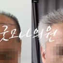 연세모나의원 | 굿모나의원 60대 대량모이식 6개월차 후기 (대반전 전후비교)