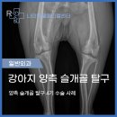 [ 동해 강릉 동물병원 ] 강아지 양측 슬개골탈구 4기 수술 및 증상