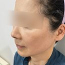 산곡믿음 | 산곡역피부과 더블메쉬 자보쇼츠 볼륨실리프팅 후기 및 효과