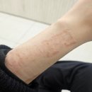 다솜약국 | 팔 흉터제거/피부이식 수술 #4 - 5개월 차 + 레이저 상담 후기 &amp; 상처관리 팁