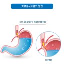 역류성 식도염 [reflux esophagitis] 이미지