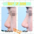 새로성형외과의원 | 짧은코 수술방법 부터 후기 사진까지