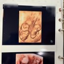 수지윤약국 | 연세하임산부인과 ( 쌍둥이 12주 4일 ) 1차 기형아 검사 후기!(니프티? 일반기형아검사?)