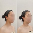 NTR | 울산 삼산동 에스테틱 아들리에드스킨 NTR 피부관리 어깨라인 수기 후기