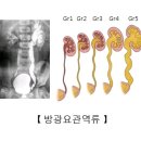 방광요관 역류[Vesicoureteral reflux] 신장 비뇨기 질환 이미지