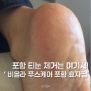 효자발 | 포항내성발톱 비올라 푸스케어 포항효자점 티눈 관리 후기
