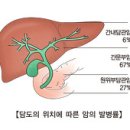 간암, 췌장암, 담도, 담관암이란? 이미지