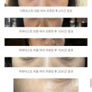 더마티스트의원 | 인천 구월동 피부과 더마티스트 첫 방문 솔직 후기(리쥬란, 사마귀, 피코프락셀) (+주의사항)