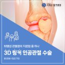 인공관절수술병원에서 알려드리는 3D 링커 인공관절 수술 이미지