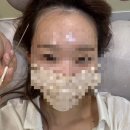 [잠실역 이담] 헤어라인 SMP 2회차 후기