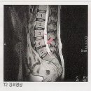 추간판헤르니아(Lumbar Disk) MRI 판독법- 도수치료 이미지