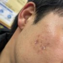 전주 얼굴볼 피지낭종 전문 병원없어서 대전 다녀옴 가격총정리