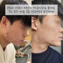 영화한의원 | 결혼준비 피부관리 수원여드름흉터 춈미흉터치료 색소침착 치료 1set후기 수원여드름전문한의원