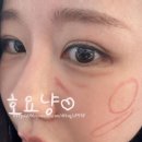 강남제이스타의원 | (제이필의원 강남점)필러 장인에게 특수부위 (눈밑/인디언밴드/옆광대) 필러 후기 내돈내산