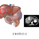 간혈관종(Hemangioma) 이미지