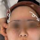 (주)더하이엔드 | 리프테라리프팅 청담피부과 하이엔드리프팅 일주일차 솔직후기