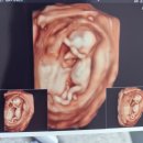 나아만 | 임신 12주차 증상 정밀초음파 입체초음파 1차기형아검사 후기