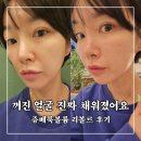 닥터리의 의료용품 | 수원동탄피부과 쥬베룩 볼륨 리볼르 꺼진얼굴 자연스럽게 채운 후기