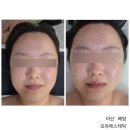 배방한라비발디아파트경로당 | 아산 배방 피부관리 포유에스테틱에서 R4U 에너지 테라피 받은 후기