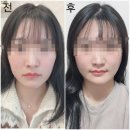 메인프라자 | 인천구월동실리프팅 민트실리프팅 붓기 변화부터 전후 비교까지 리얼 내돈내산 후기
