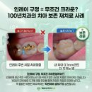 100년치과의원 | 인레이 구멍 났다면 무조건 크라운? 100년치과의 '치아 보존' 재치료 증례