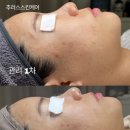예민여드름 피부, 필링 가능한 곳｜추러스스킨케어 송파 후기