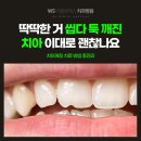 더블유치과기공소 | 해운대좌동치과 툭 깨진 치아 이대로 괜찮을까요?