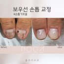 노가(NOGA)네일&뷰티 | 광주 물어뜯는 손톱 교정 노가인증샵 줄라이코코 네일바디 기르기 엄지손톱교정