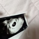 보성아산병원_지상3층 병동(1구역) | 천안아산 삼성미즈병원 소파술 후기,유산 판정까지 과정