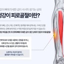 수내정형외과 오치헌원장 진료 후기, 피로골절 제대로 알아보기