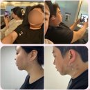 셀피성형외과 | <reveiw> 이중턱근육묶기, 이중턱지방흡입,셀피성형외과,서면 성형외과,이중턱 근육묶기+지흡 후기