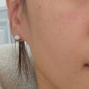 예젤의원 | 예젤의원 흑자 제거 한 달 경과 후기